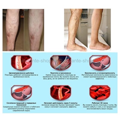 Антиварикозные пластыри KanyeHB Varicose Veins Plaster 6 шт (106)